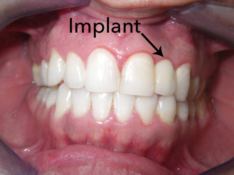 Dental Implants C.E. Solano, D.M.D. Oral & Maxillofacial Surgery