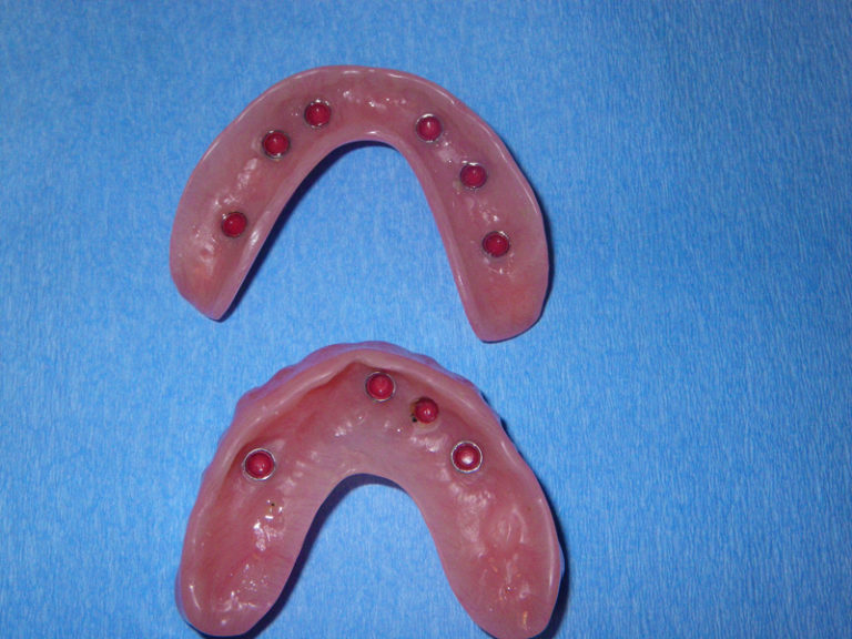 Dental Implants C.E. Solano, D.M.D. Oral & Maxillofacial Surgery