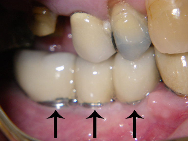 Dental Implants C.E. Solano, D.M.D. Oral & Maxillofacial Surgery
